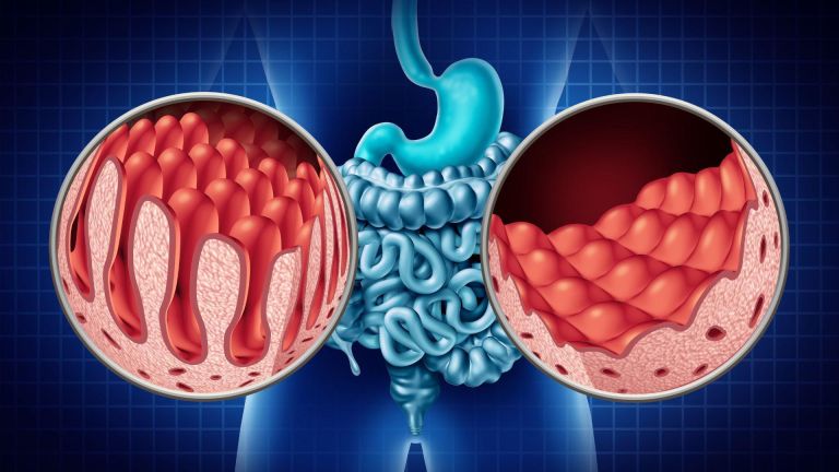Reizdarmsyndrom und Leaky Gut – der Weg zur Besserung