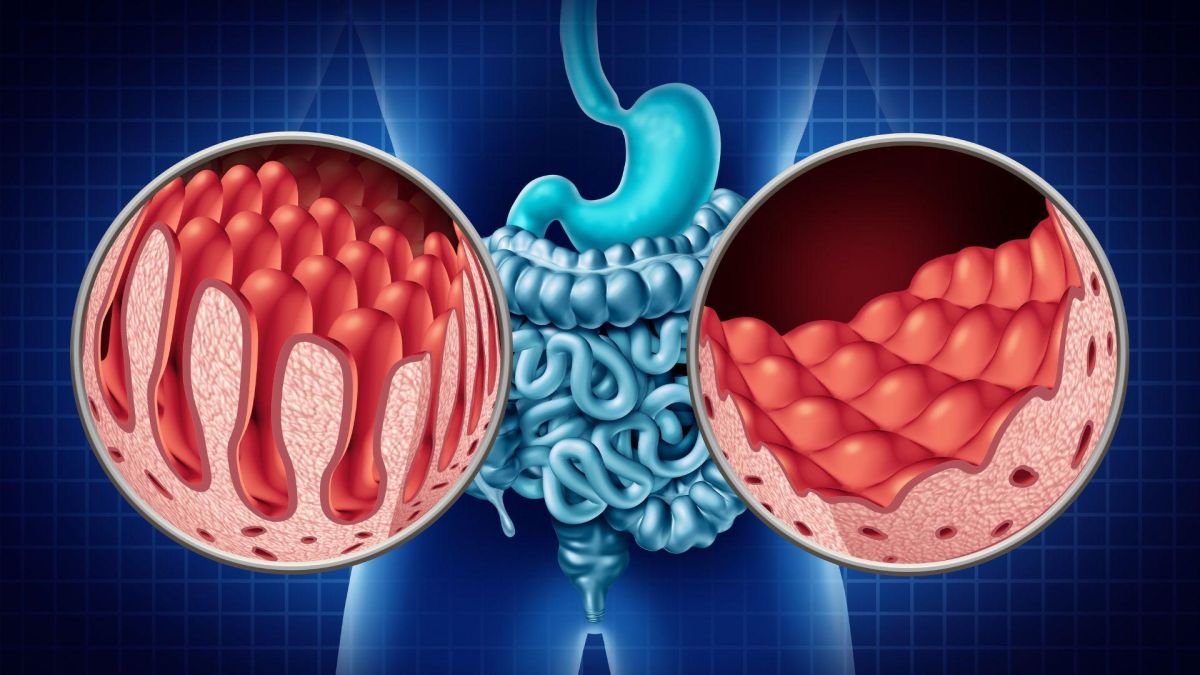 Reizdarmsyndrom und Leaky Gut – der Weg zur Besserung
